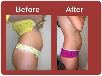 Mesotherapy: great results without downtime